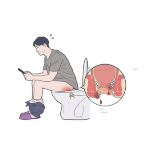 Anorectal