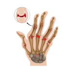 Arthritis