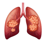 Respiratory Disorders