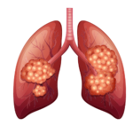 Respiratory Disorders