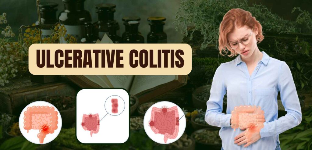 Ulcerative Colitis 1 Ulcerative Colitis