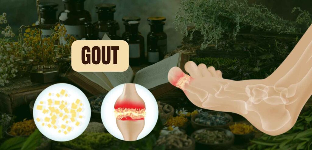 Gout (Arthritis) 1 Gout Arthritis