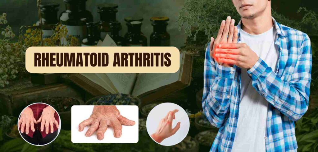 Rheumatoid Arthritis 1 Rheumatoid Arthritis