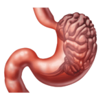 gastro disease