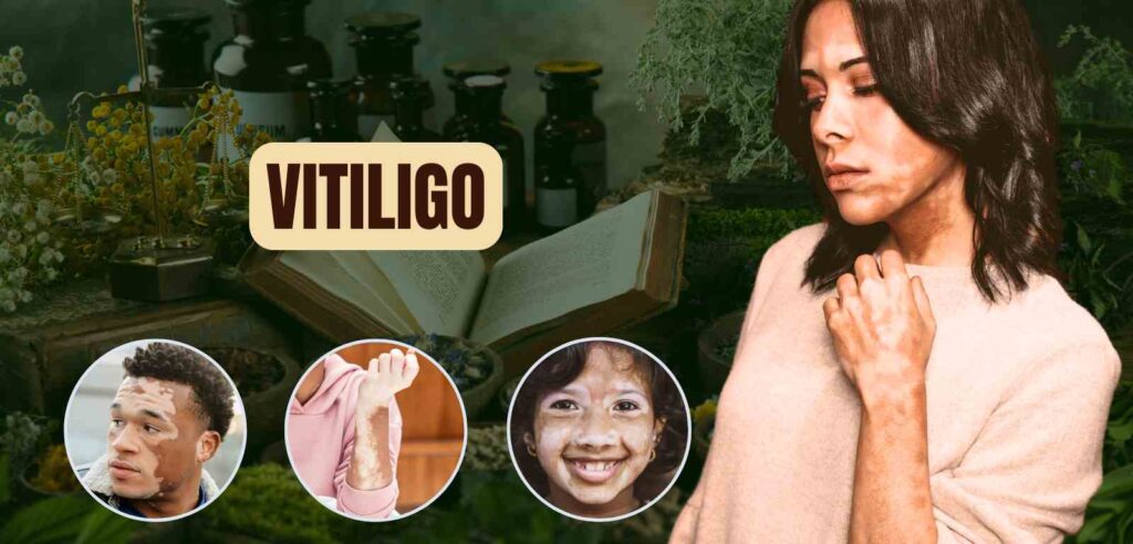 Vitiligo 1 Vitiligo