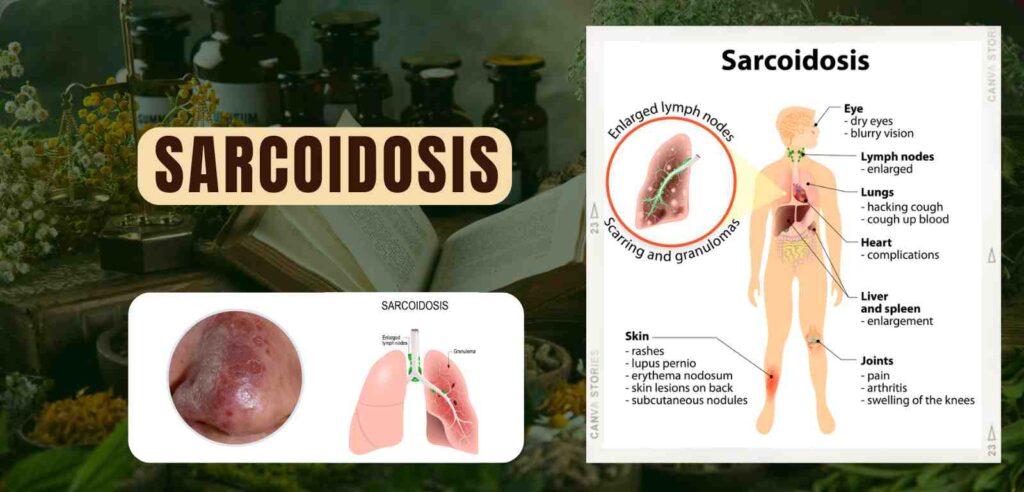 Sarcoidosis 1 Sarcoidosis