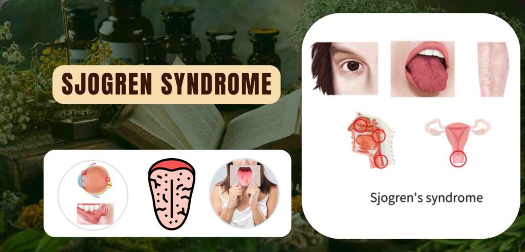 Sjogren Syndrome