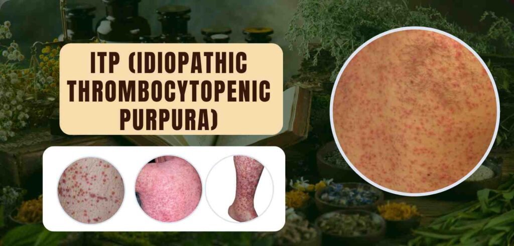 ITP 1 ITP (Idiopathic Thrombocytopenic Purpura)
