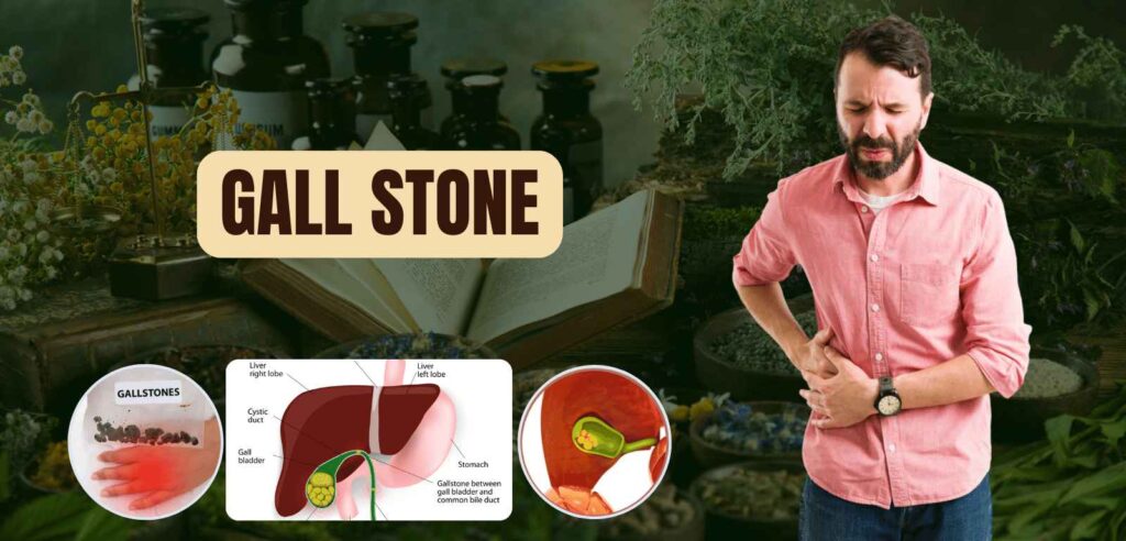 Gall stones 1 Gall stones