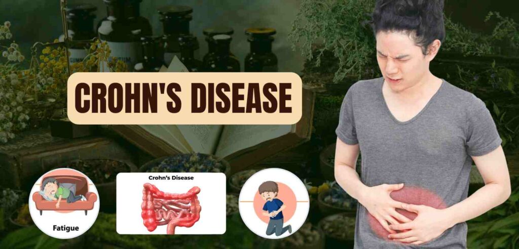 Crohn's Disease
