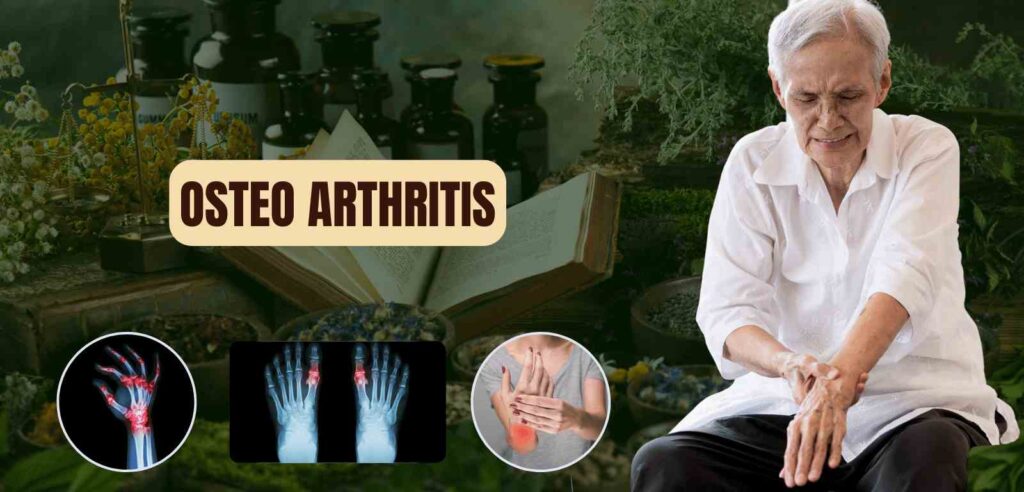 Osteo Arthritis 1 Osteo Arthritis